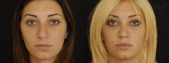Before & After Chin Implant Case 74 Front View in Los Angeles, CA