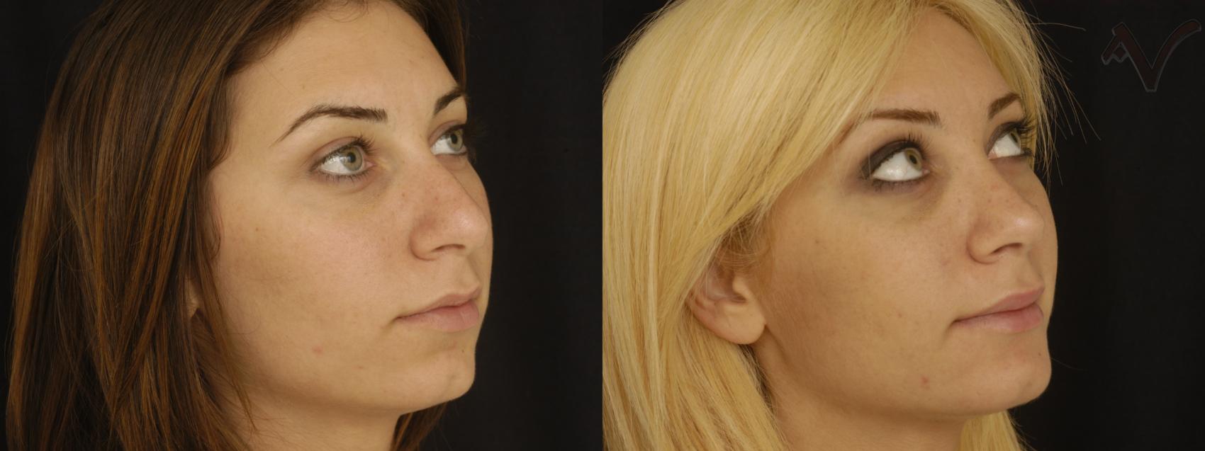 Before & After Rhinoplasty Case 74 Right Oblique View in Los Angeles, CA