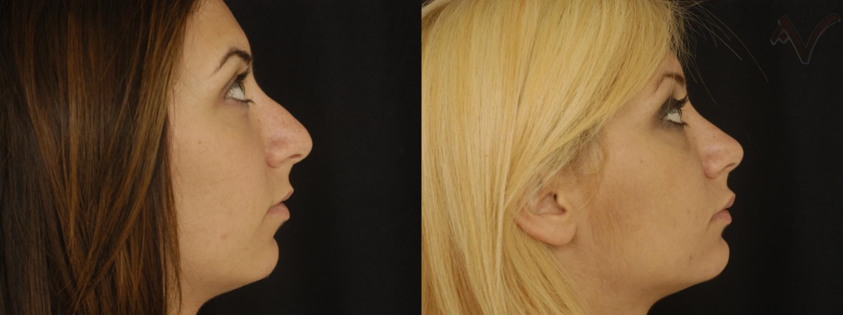 Before & After Rhinoplasty Case 74 Right Side View in Los Angeles, CA