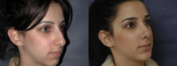 Before & After Chin Implant Case 75 Right Oblique View in Los Angeles, CA