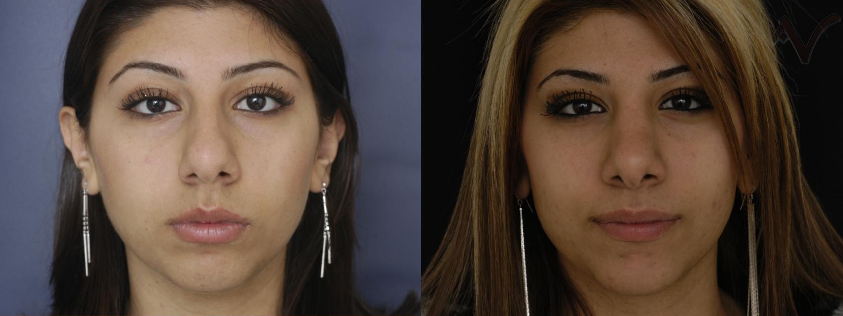 Before & After Chin Implant Case 76 Front View in Burbank, CA