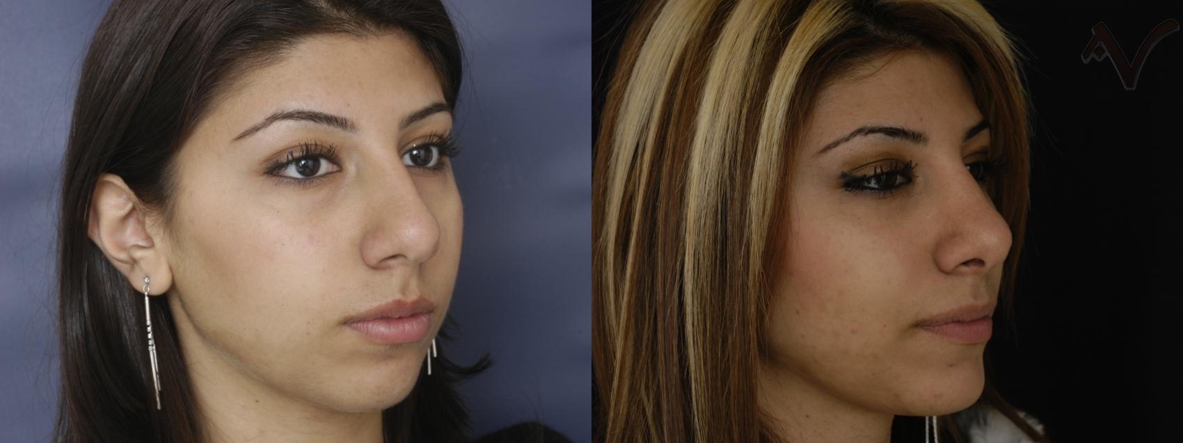 Before & After Chin Implant Case 76 Right Oblique View in Burbank, CA