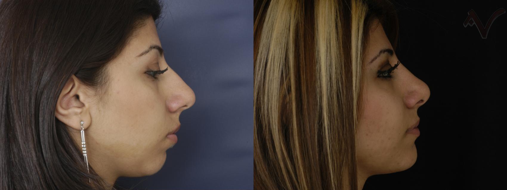 Before & After Chin Implant Case 76 Right Side View in Burbank, CA