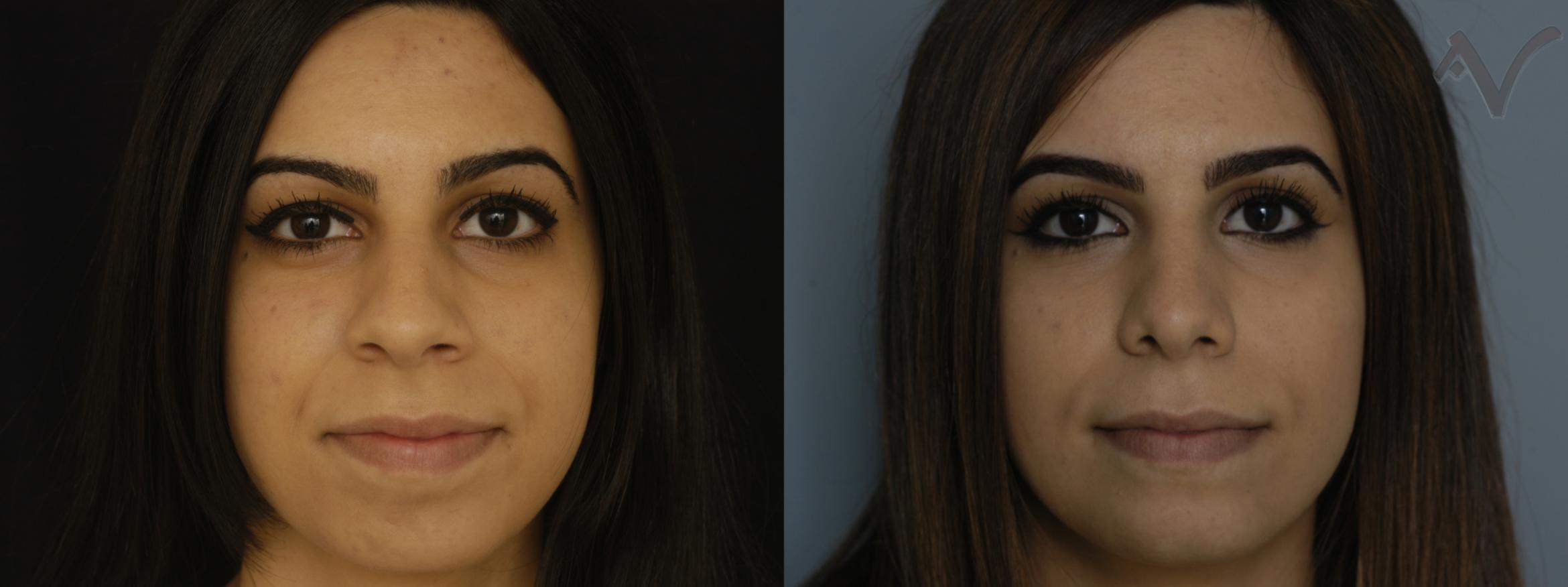 Before & After Chin Implant Case 77 Front View in Burbank, CA