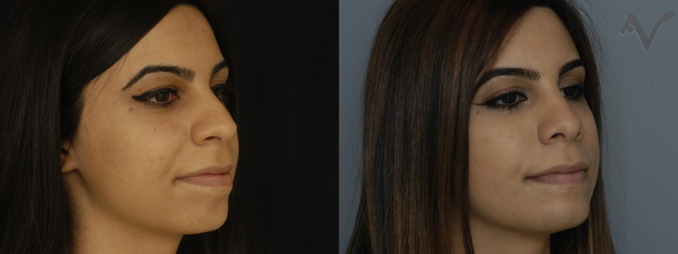 Before & After Chin Implant Case 77 Right Oblique View in Burbank, CA