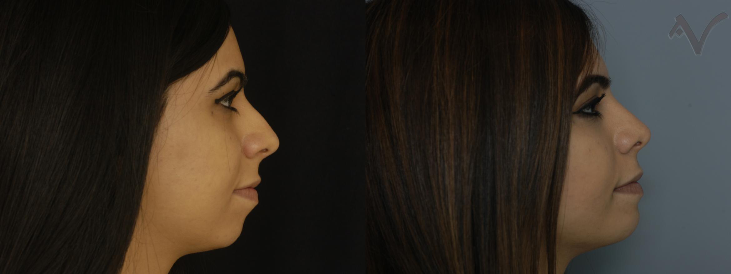 Before & After Chin Implant Case 77 Right Side View in Burbank, CA