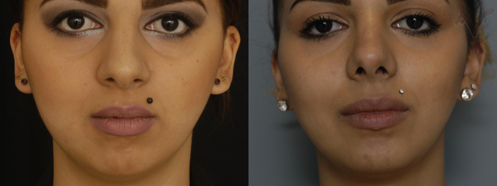 Before & After Rhinoplasty Case 78 Front View in Burbank, CA