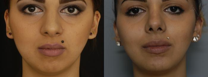 Before & After Rhinoplasty Case 78 Front View in Los Angeles, CA