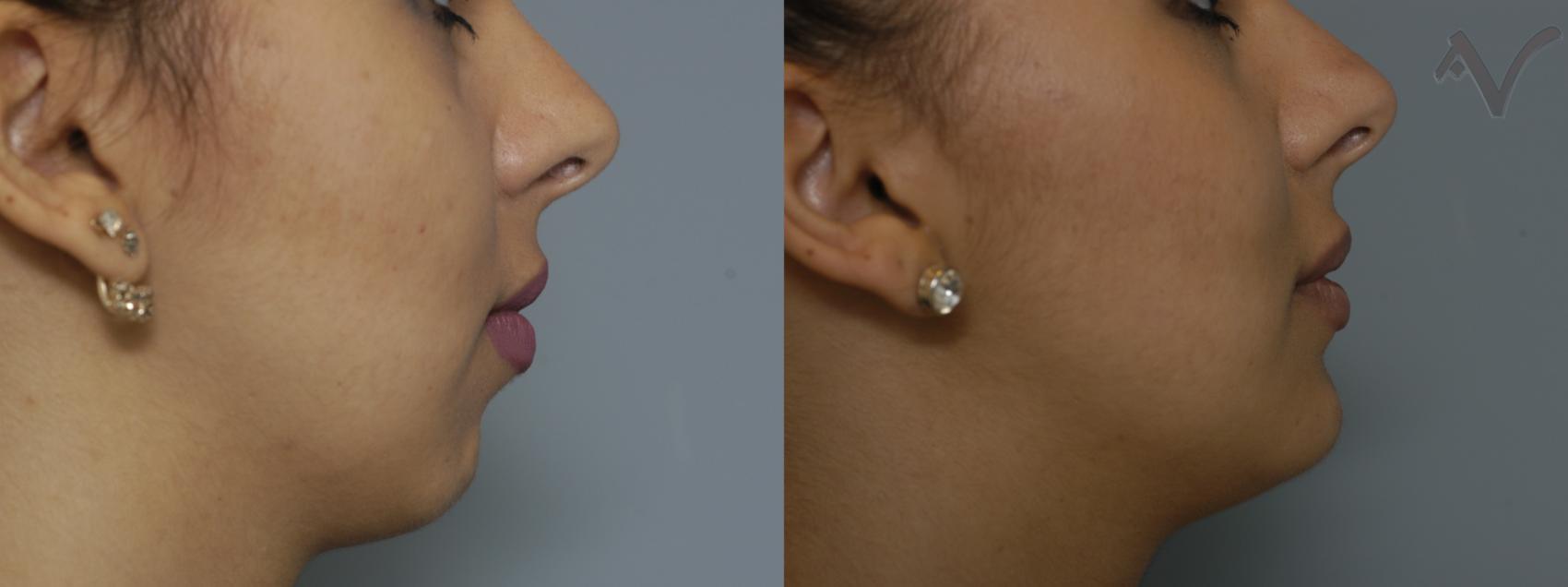 Before & After Rhinoplasty Case 78 Right Side View in Burbank, CA