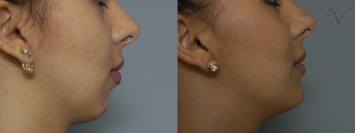 Before & After Chin Implant Case 78 Right Side View in Los Angeles, CA