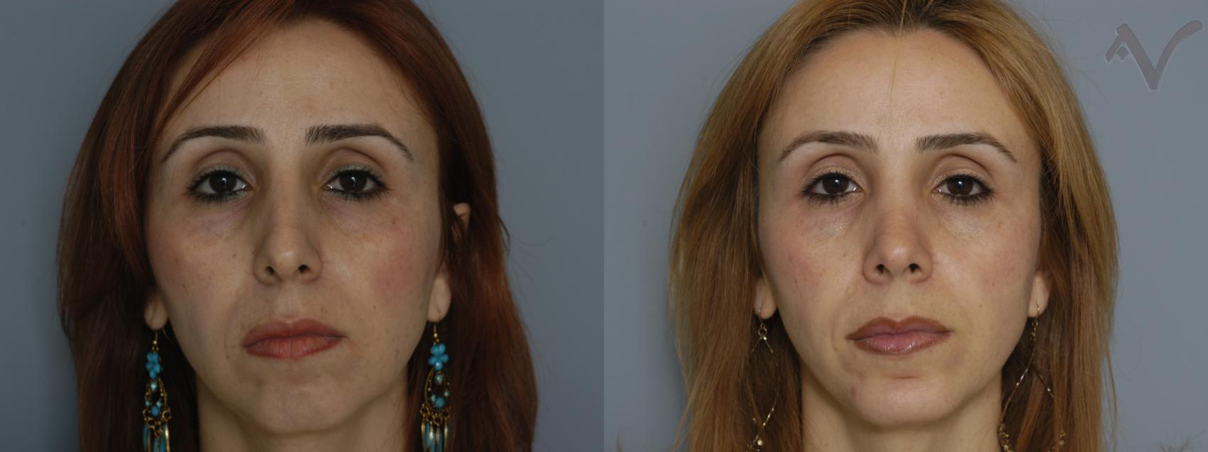 Before & After Rhinoplasty Case 80 Front View in Burbank, CA