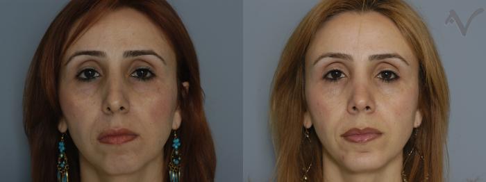 Before & After Rhinoplasty Case 80 Front View in Los Angeles, CA