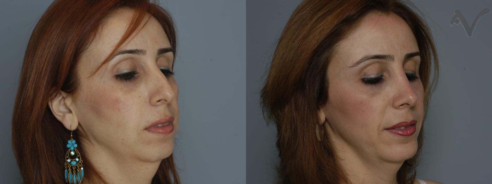 Before & After Chin Implant Case 80 Right Oblique View in Los Angeles, CA