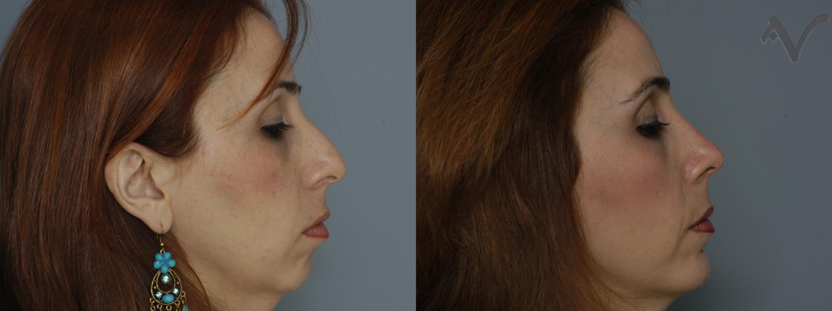 Before & After Rhinoplasty Case 80 Right Side View in Los Angeles, CA