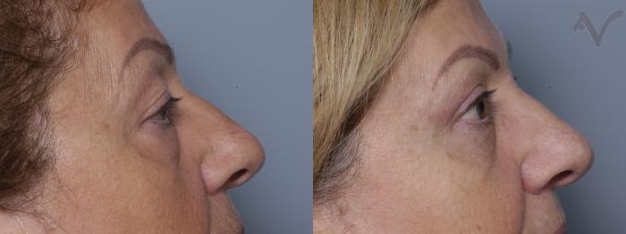 Before & After Combined Upper & Lower Eyelid Surgery Case 278 Right Side View in Los Angeles, CA