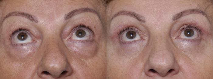 Before & After Combined Upper & Lower Eyelid Surgery Case 278 Upward Look View in Los Angeles, CA