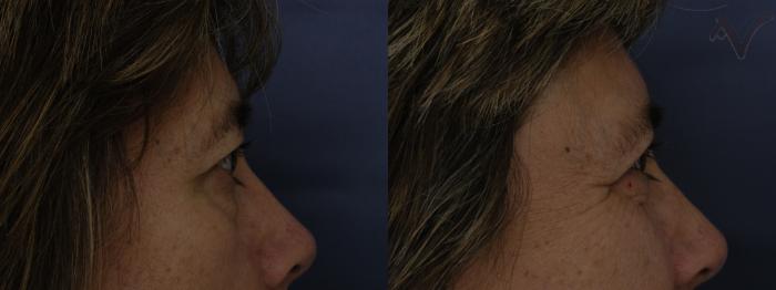 Before & After Combined Upper & Lower Eyelid Surgery Case 286 Right Side View in Los Angeles, CA