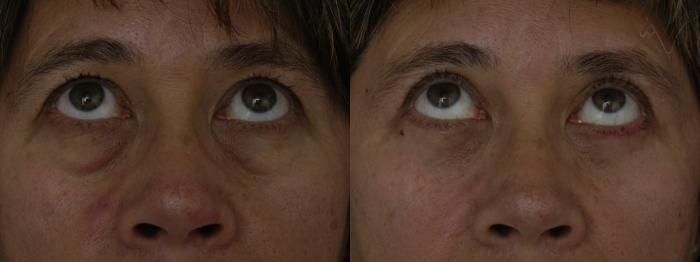 Before & After Combined Upper & Lower Eyelid Surgery Case 286 Upward Look View in Los Angeles, CA