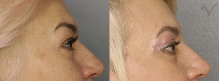 Before & After Combined Upper & Lower Eyelid Surgery Case 290 Right Side View in Los Angeles, CA