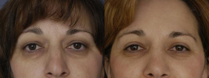 Before & After Combined Upper & Lower Eyelid Surgery Case 294 Front View in Los Angeles, CA