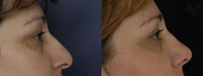 Before & After Combined Upper & Lower Eyelid Surgery Case 294 Right Side View in Los Angeles, CA