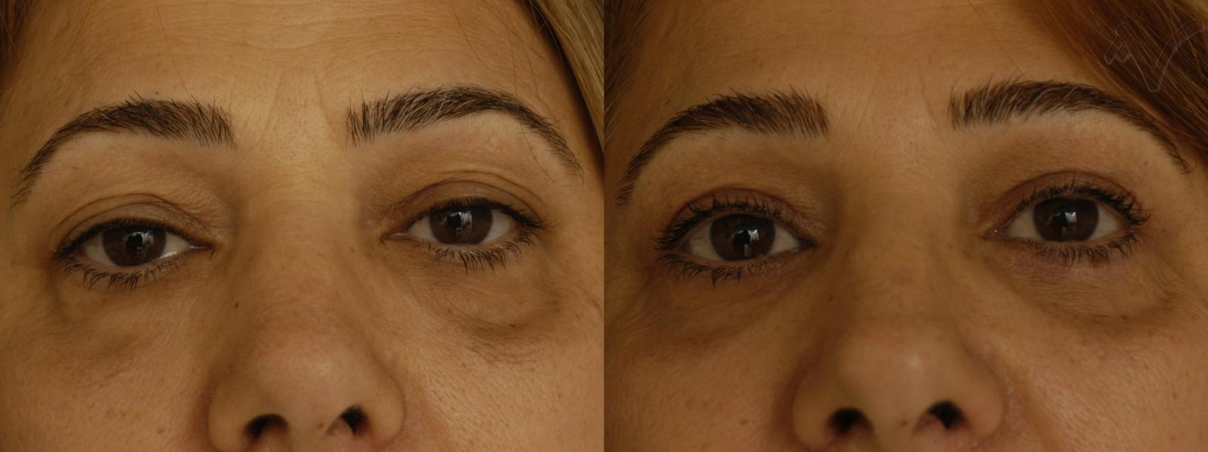 Before & After Combined Upper & Lower Eyelid Surgery Case 312 Front View in Los Angeles, CA