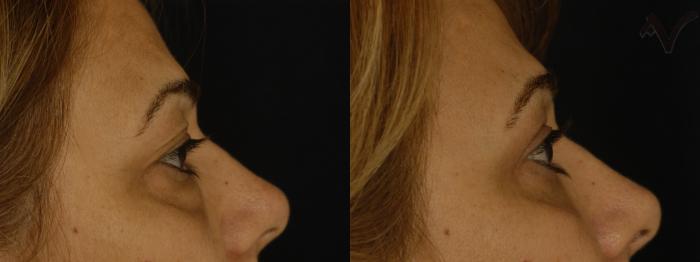 Before & After Combined Upper & Lower Eyelid Surgery Case 312 Right Side View in Los Angeles, CA