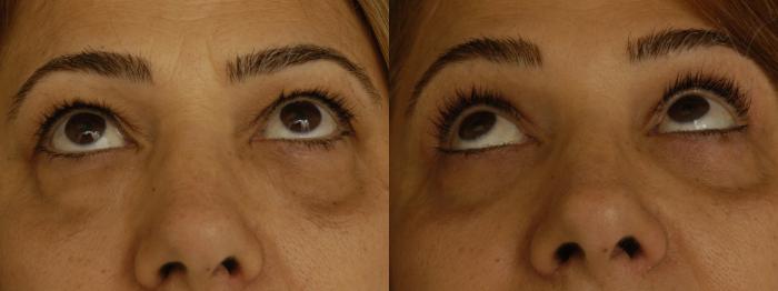 Before & After Combined Upper & Lower Eyelid Surgery Case 312 Upward Look View in Los Angeles, CA