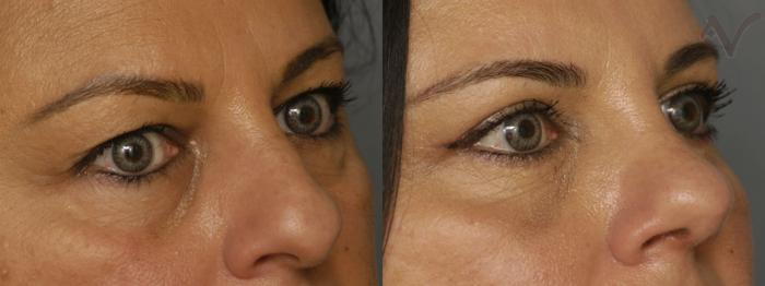 Before & After Combined Upper & Lower Eyelid Surgery Case 341 Right Oblique View in Los Angeles, CA
