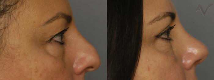 Before & After Combined Upper & Lower Eyelid Surgery Case 341 Right Side View in Los Angeles, CA