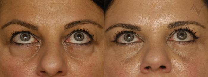 Before & After Combined Upper & Lower Eyelid Surgery Case 341 Upward Look View in Los Angeles, CA
