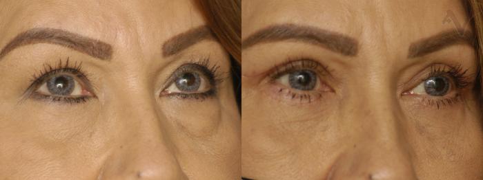 Before & After Combined Upper & Lower Eyelid Surgery Case 342 Right Oblique View in Los Angeles, CA