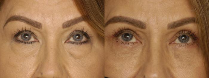 Before & After Combined Upper & Lower Eyelid Surgery Case 342 Upward Look View in Los Angeles, CA