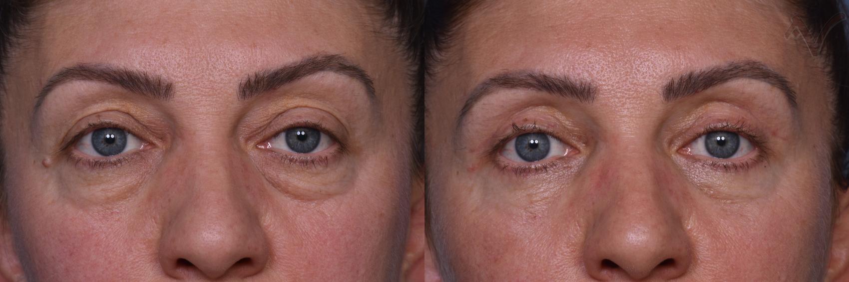 Before & After Combined Upper & Lower Eyelid Surgery Case 436 Front View in Los Angeles, CA