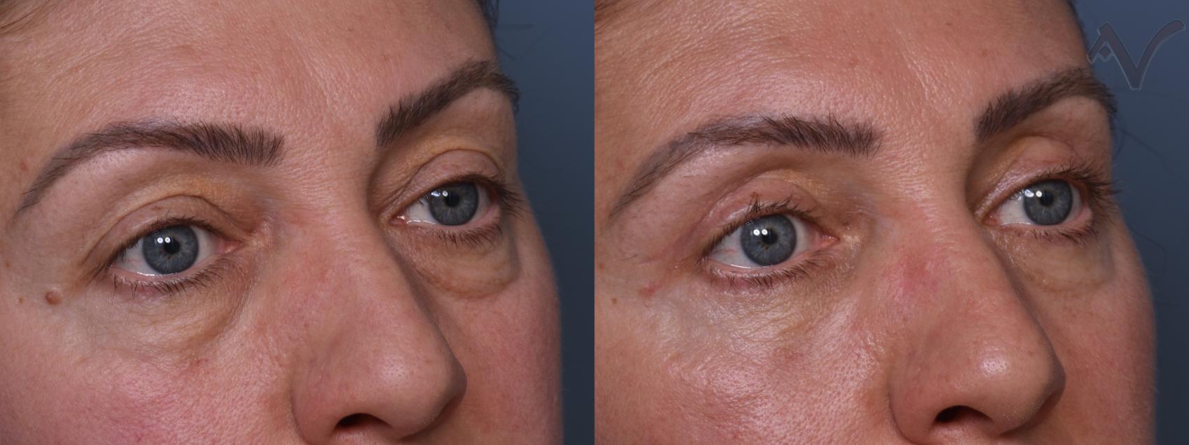 Before & After Combined Upper & Lower Eyelid Surgery Case 436 Right Oblique View in Los Angeles, CA