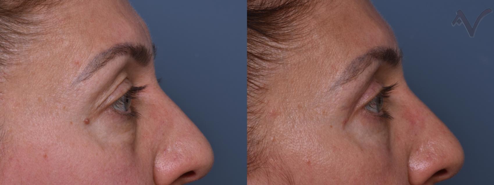 Before & After Combined Upper & Lower Eyelid Surgery Case 436 Right Side View in Los Angeles, CA