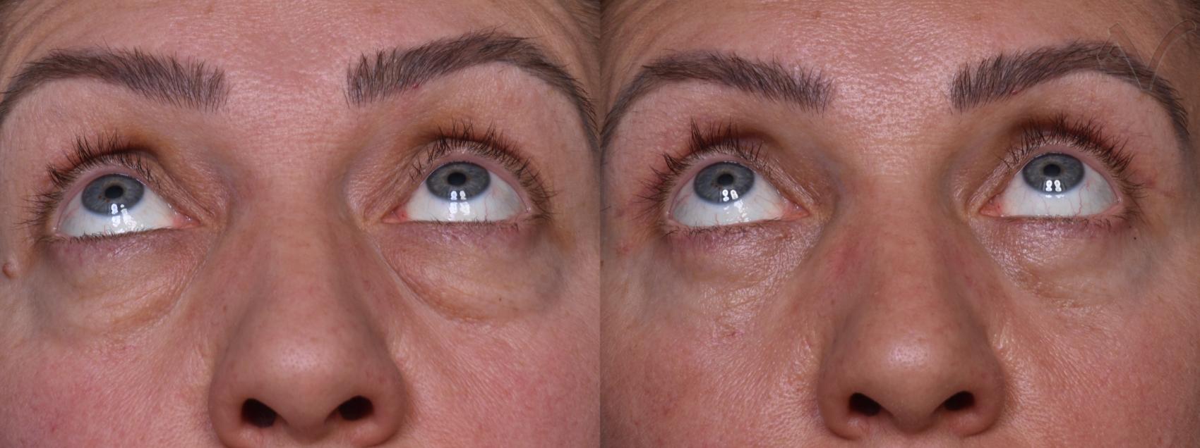 Before & After Combined Upper & Lower Eyelid Surgery Case 436 Upward Gaze View in Los Angeles, CA