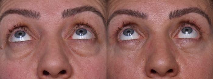 Before & After Combined Upper & Lower Eyelid Surgery Case 436 Upward Gaze View in Los Angeles, CA