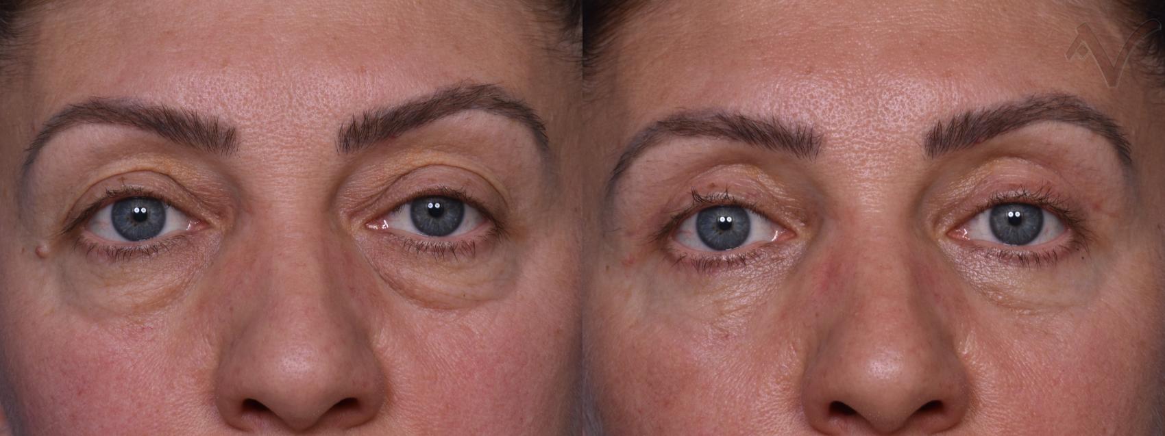 Before & After Combined Upper & Lower Eyelid Surgery Case 437 Front View in Los Angeles, CA