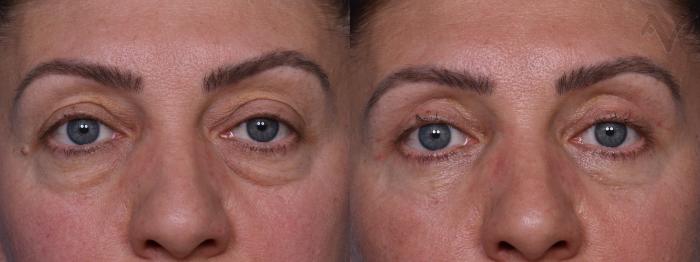 Before & After Combined Upper & Lower Eyelid Surgery Case 437 Front View in Los Angeles, CA