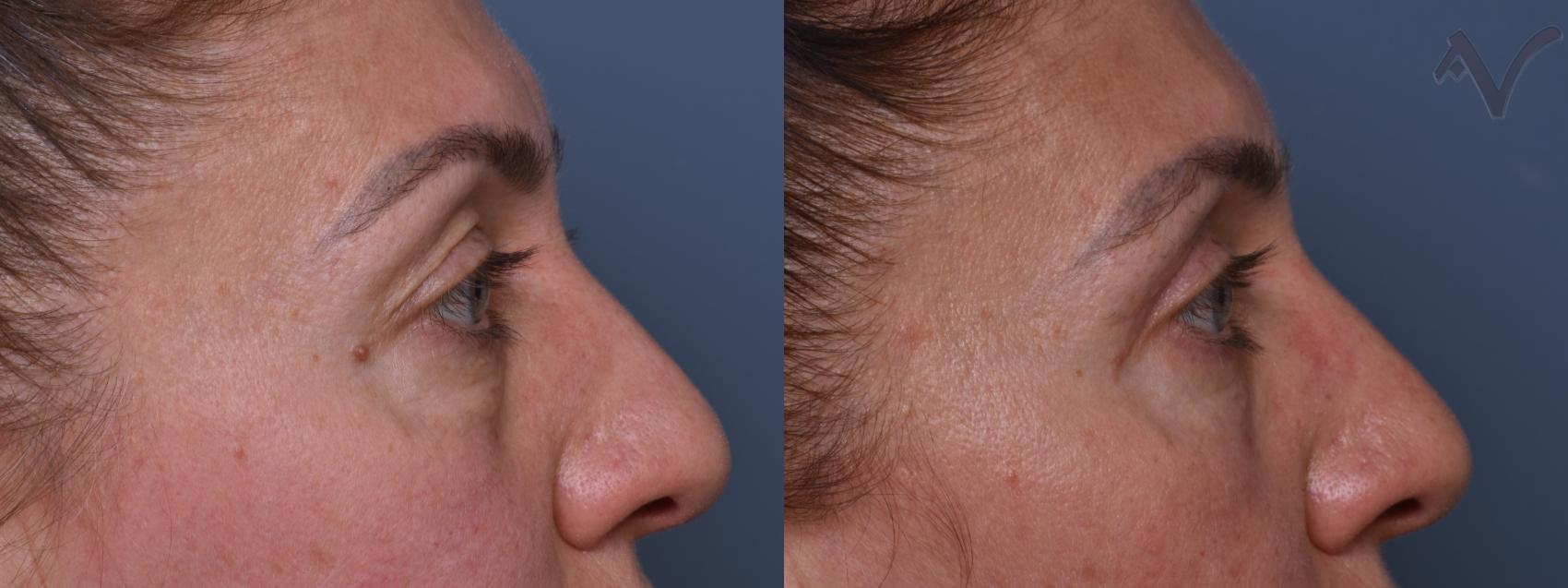 Before & After Combined Upper & Lower Eyelid Surgery Case 437 Right Side View in Los Angeles, CA