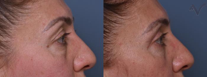 Before & After Combined Upper & Lower Eyelid Surgery Case 437 Right Side View in Los Angeles, CA