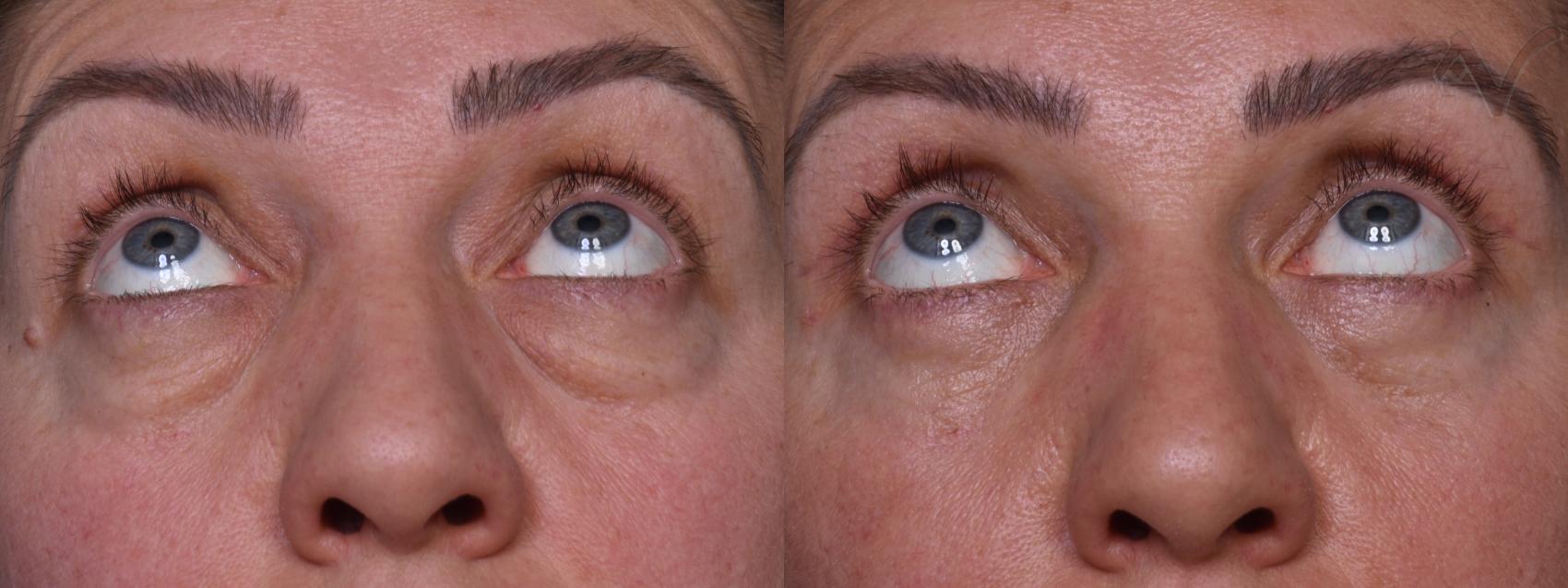 Before & After Combined Upper & Lower Eyelid Surgery Case 437 Upward Gaze View in Los Angeles, CA