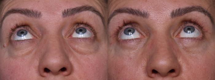 Before & After Combined Upper & Lower Eyelid Surgery Case 437 Upward Gaze View in Los Angeles, CA