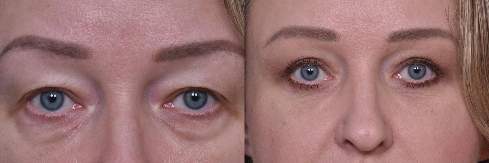 Before & After Combined Upper & Lower Eyelid Surgery Case 439 Front View in Los Angeles, CA