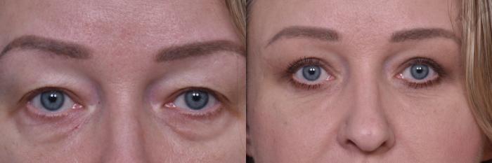 Before & After Combined Upper & Lower Eyelid Surgery Case 439 Front View in Los Angeles, CA