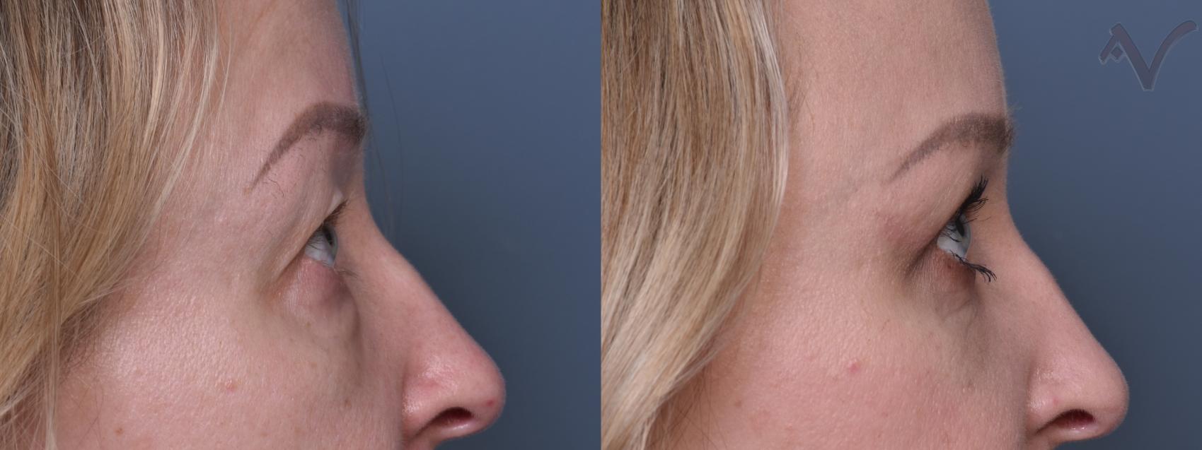 Before & After Combined Upper & Lower Eyelid Surgery Case 439 Right Side View in Los Angeles, CA
