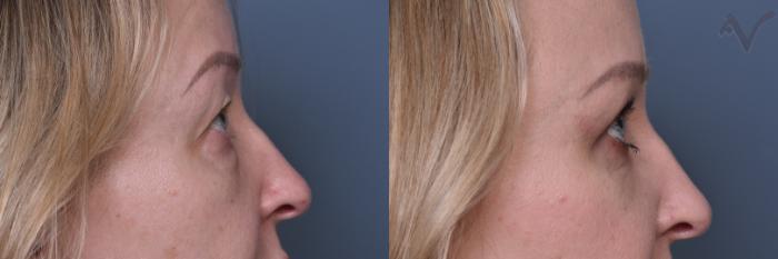 Before & After Combined Upper & Lower Eyelid Surgery Case 439 Right Side View in Los Angeles, CA