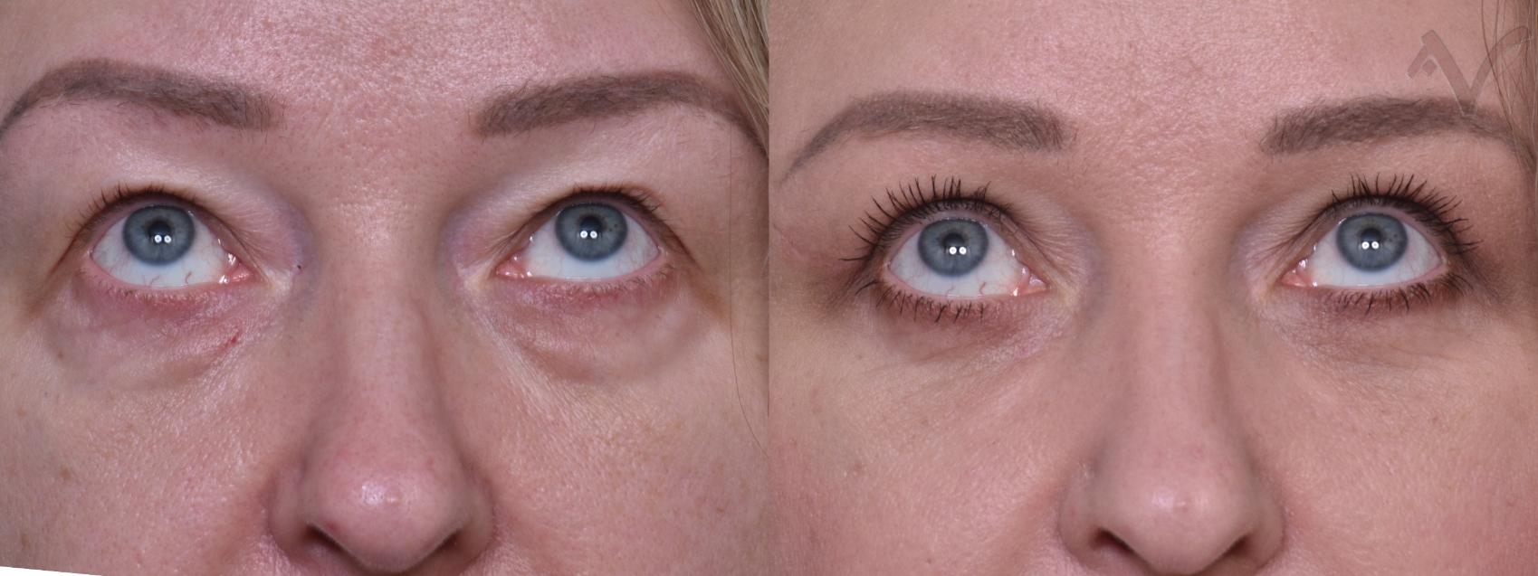 Before & After Combined Upper & Lower Eyelid Surgery Case 439 Upward Gaze View in Los Angeles, CA