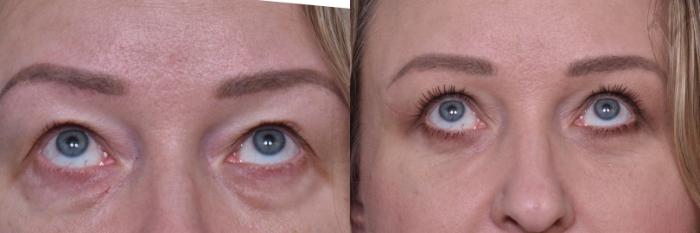 Before & After Combined Upper & Lower Eyelid Surgery Case 439 Upward Gaze View in Los Angeles, CA